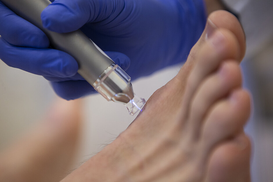 Nahaufnahme einer Lasertherapie an einem Fuß