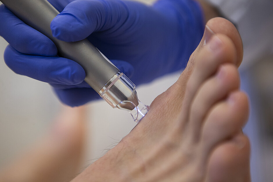 Nahaufnahme einer Lasertherapie an einem Fuß